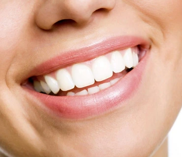 teeth-whitening
